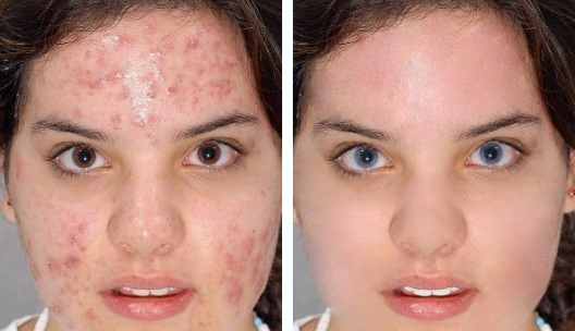 Pimple/Blemish Removal and Skin Smoothing 